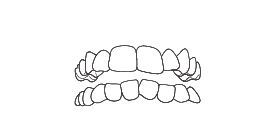 Crowded teeth