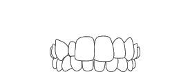 Malocclusion