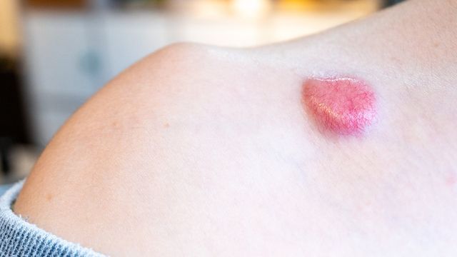 Mohs Surgery — Victorville, CA — High Desert Skin Center
