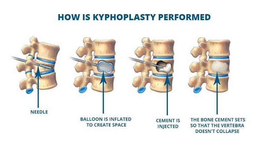 kyphoplasty infographic