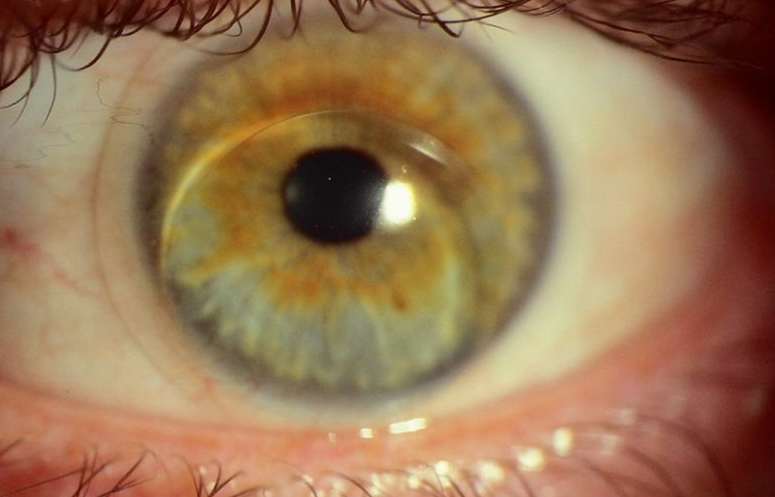 Paciente con ectasia severa corneal