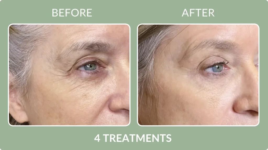 Before-and-after close-up of an eye area with smoother skin after four treatments.