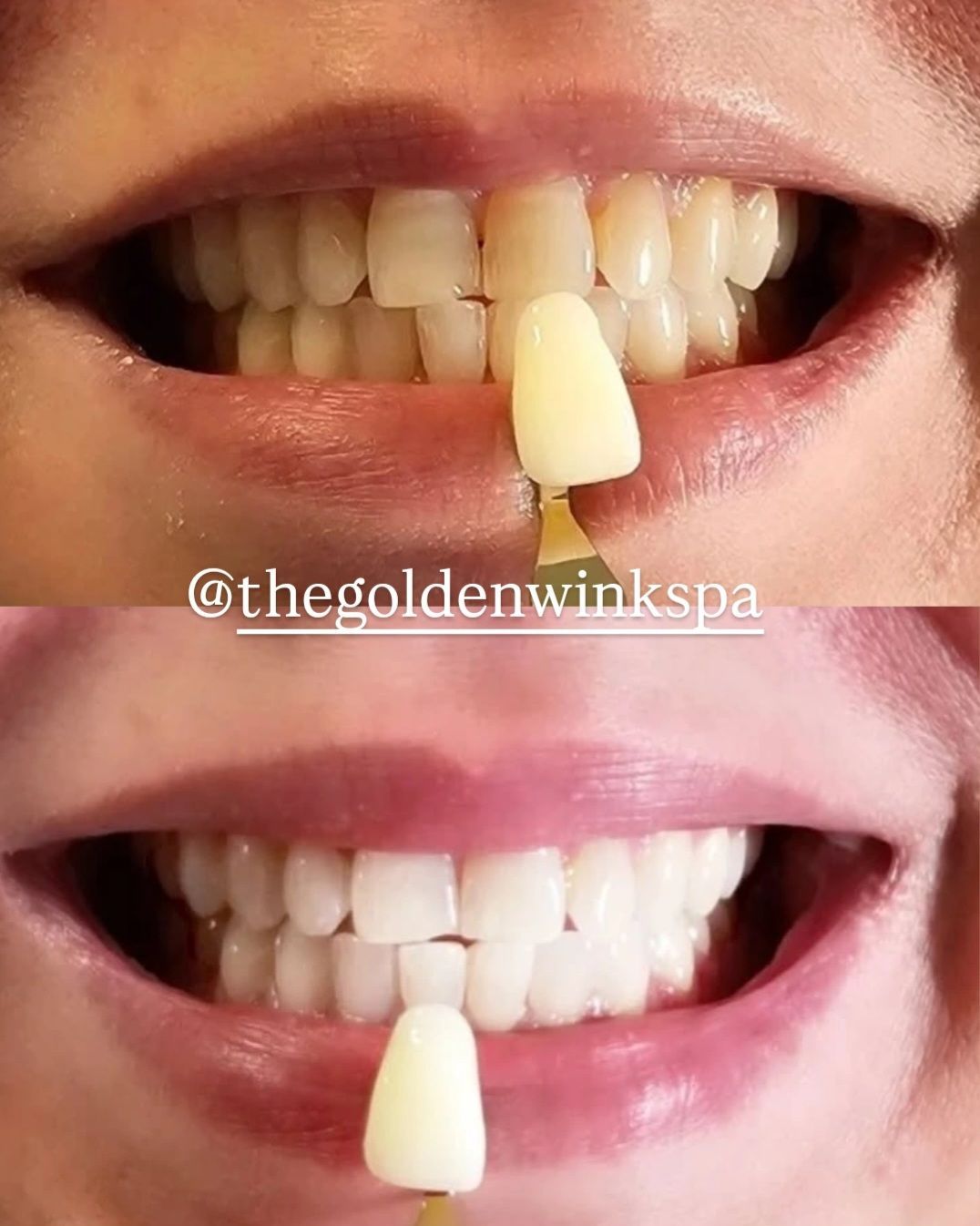 A before and after photo of a woman 's teeth.