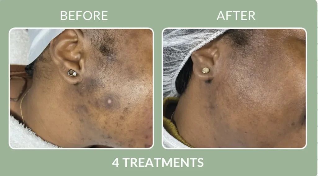 Before-and-after side profile of a neck skin area, showing reduced dark spots after 4 treatments.