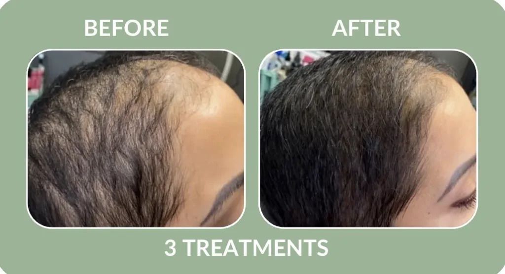 Before-and-after scalp treatment: thinning hair before, fuller hair after, labeled “3 Treatments”