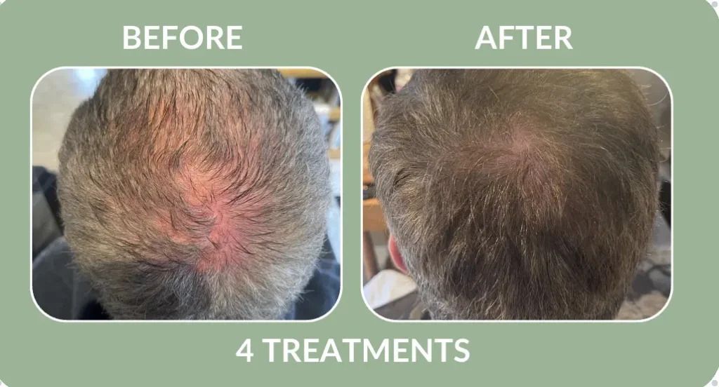 Before-and-after scalp photos showing reduced redness after 4 treatments.