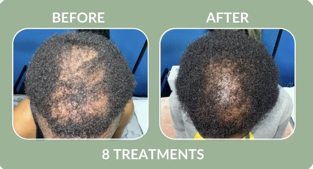 Before-and-after scalp photos showing reduced hair loss after 8 treatments.