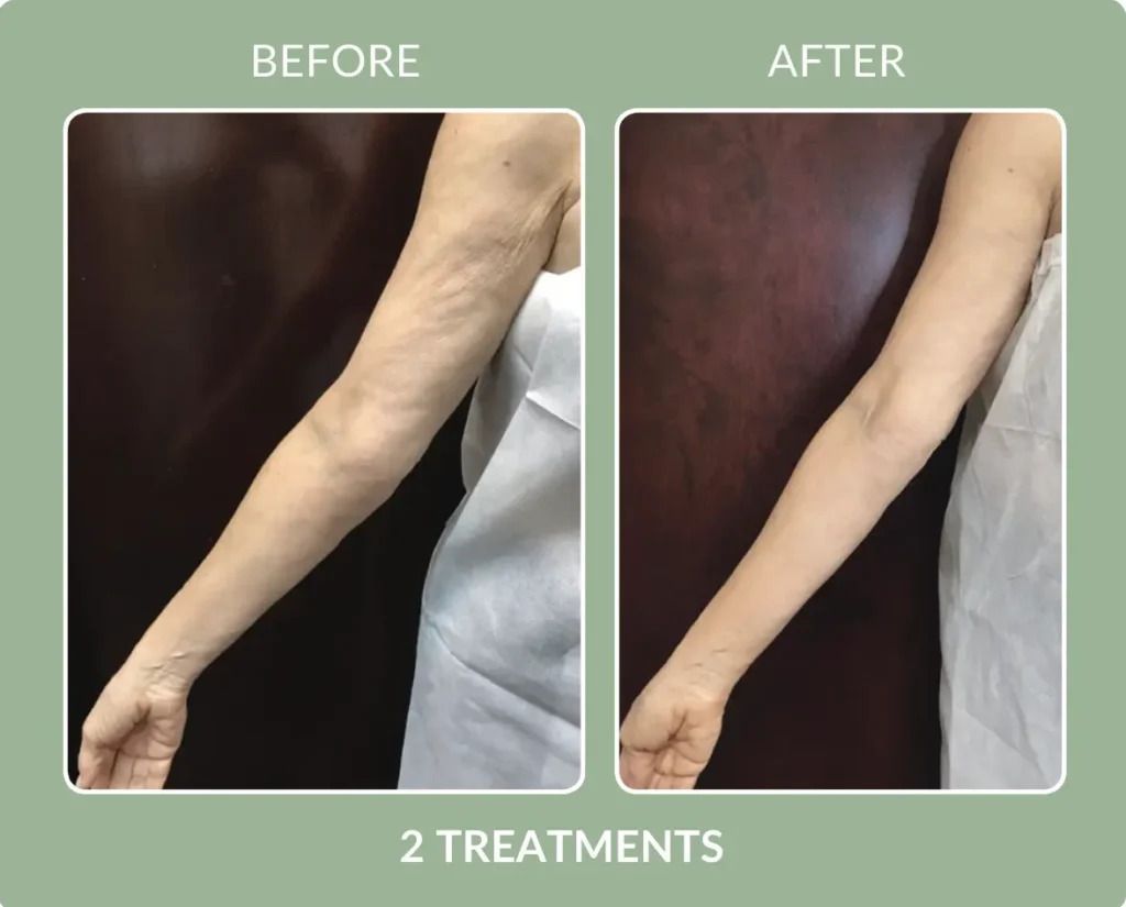 Before-and-after arm photos labeled “2 treatments,” showing reduced wrinkles and firmer skin