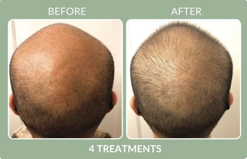 Before-and-after scalp photo showing hair regrowth after 4 treatments.