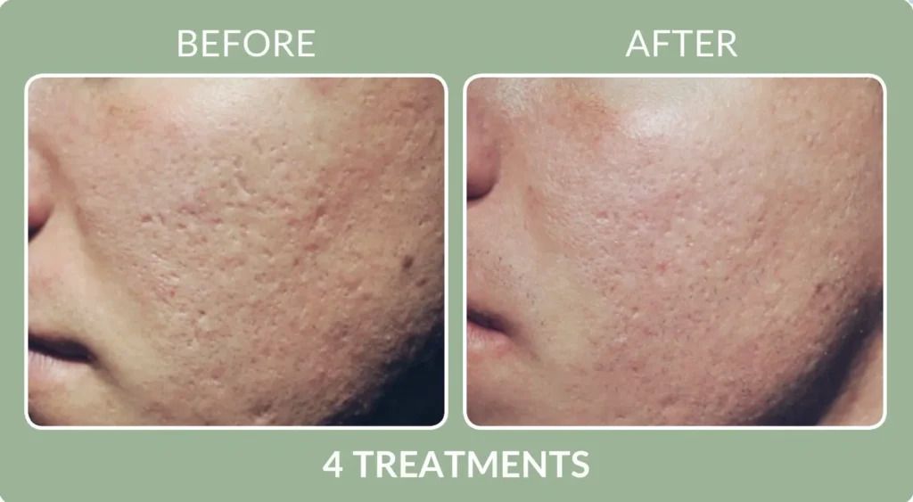 Before-and-after close-up of skin texture improvement after 4 treatments, with reduced acne scars.