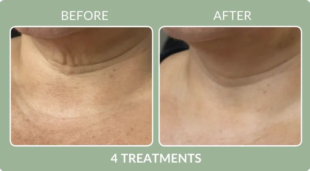 Before-and-after close-up of neck skin, showing reduced redness after 4 treatments