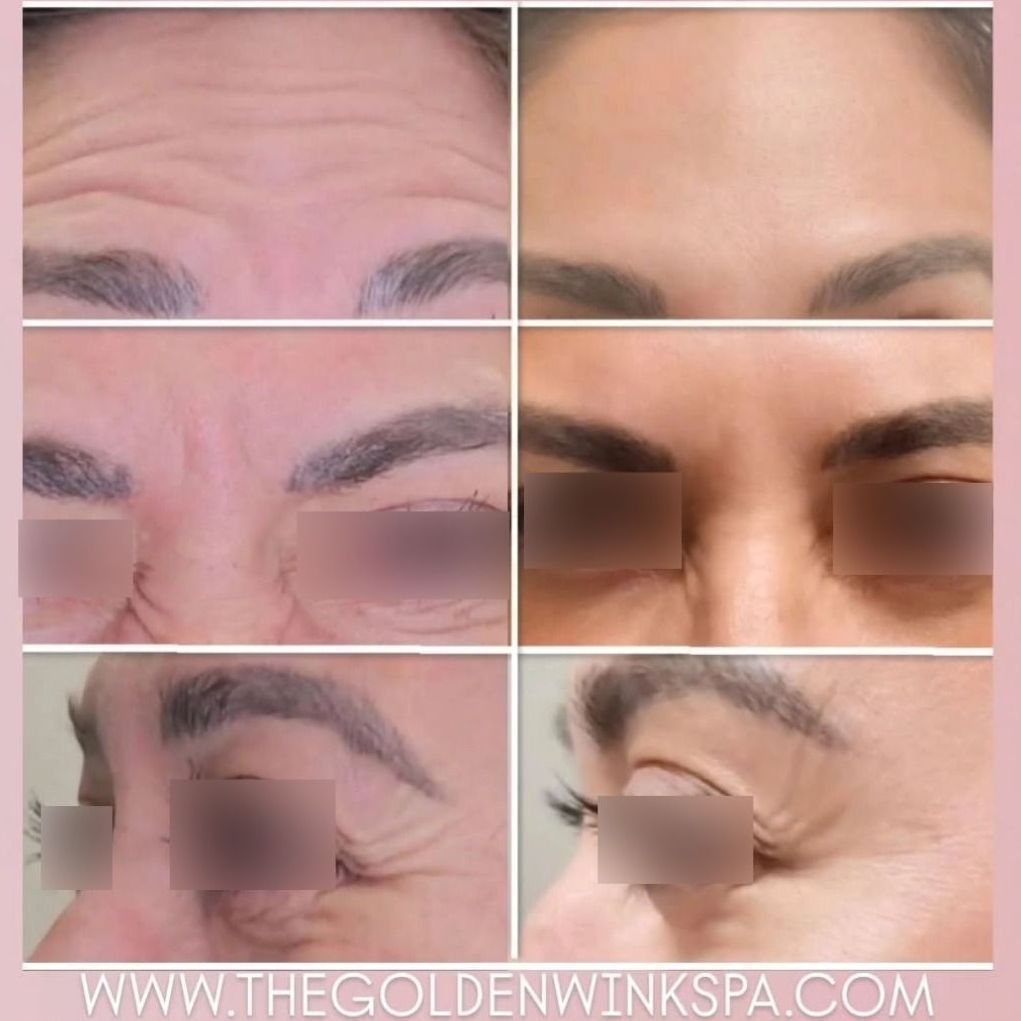 A before and after photo of a woman 's forehead
