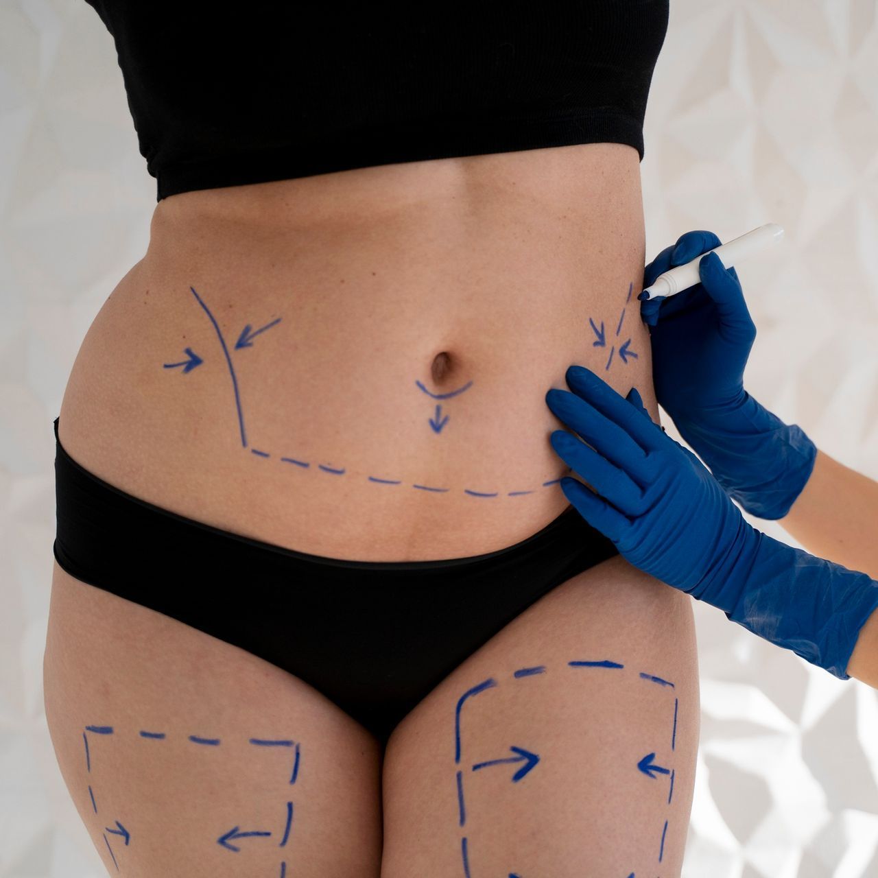A woman in black underwear is getting a surgery on her stomach.