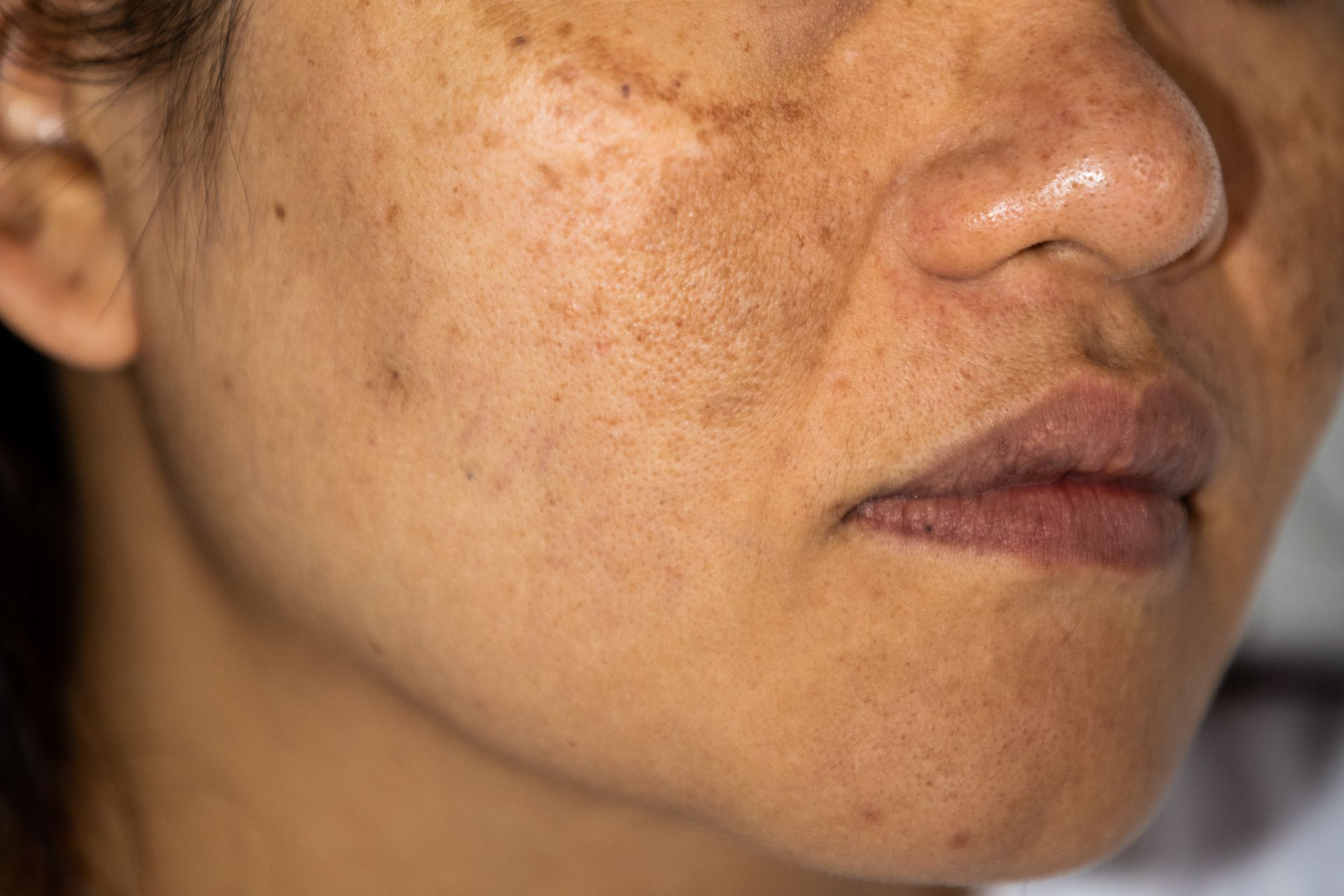 Close-up of a face with dark facial freckles and a neutral expression.