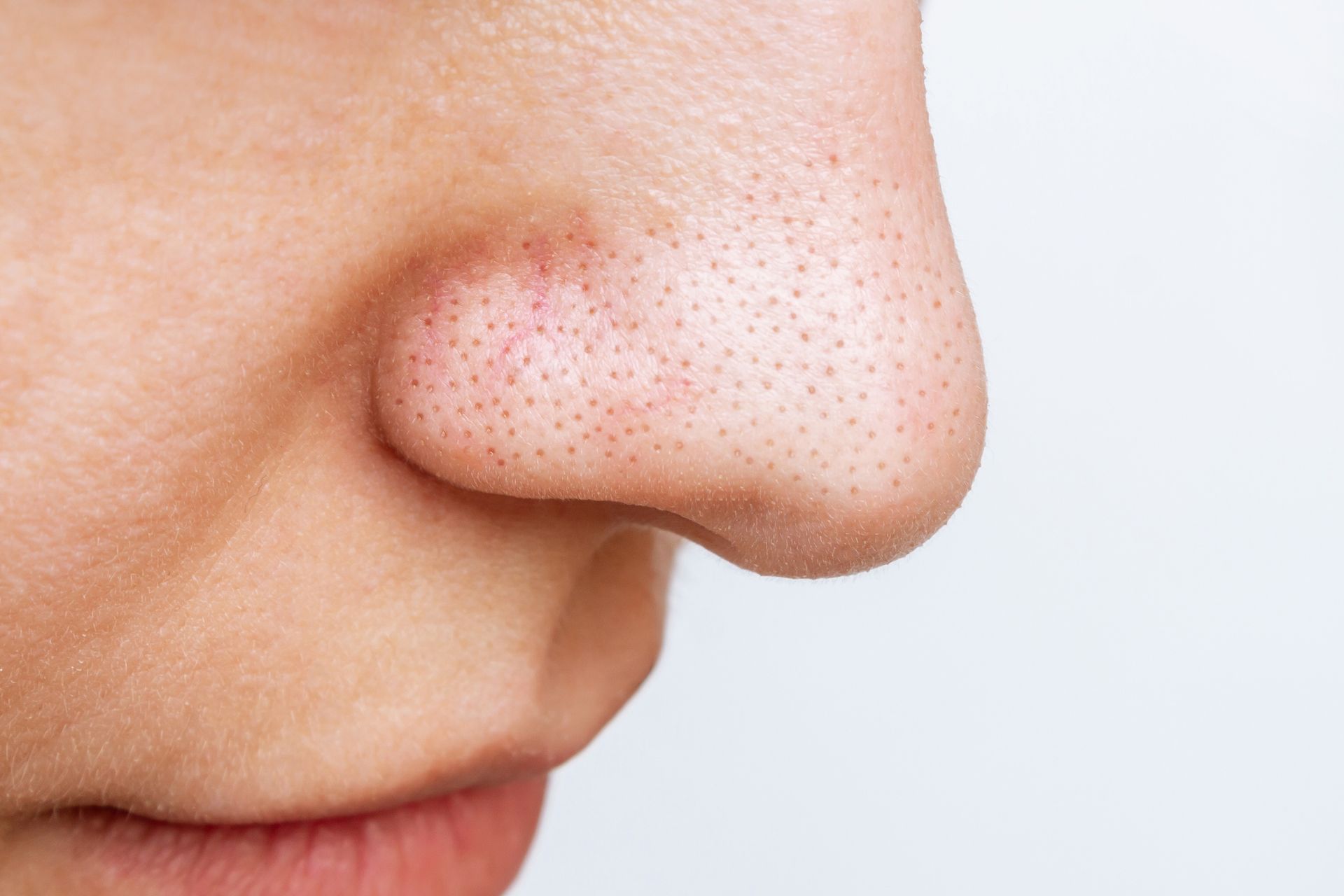 Close-up of a nose with visible blackheads on a light background