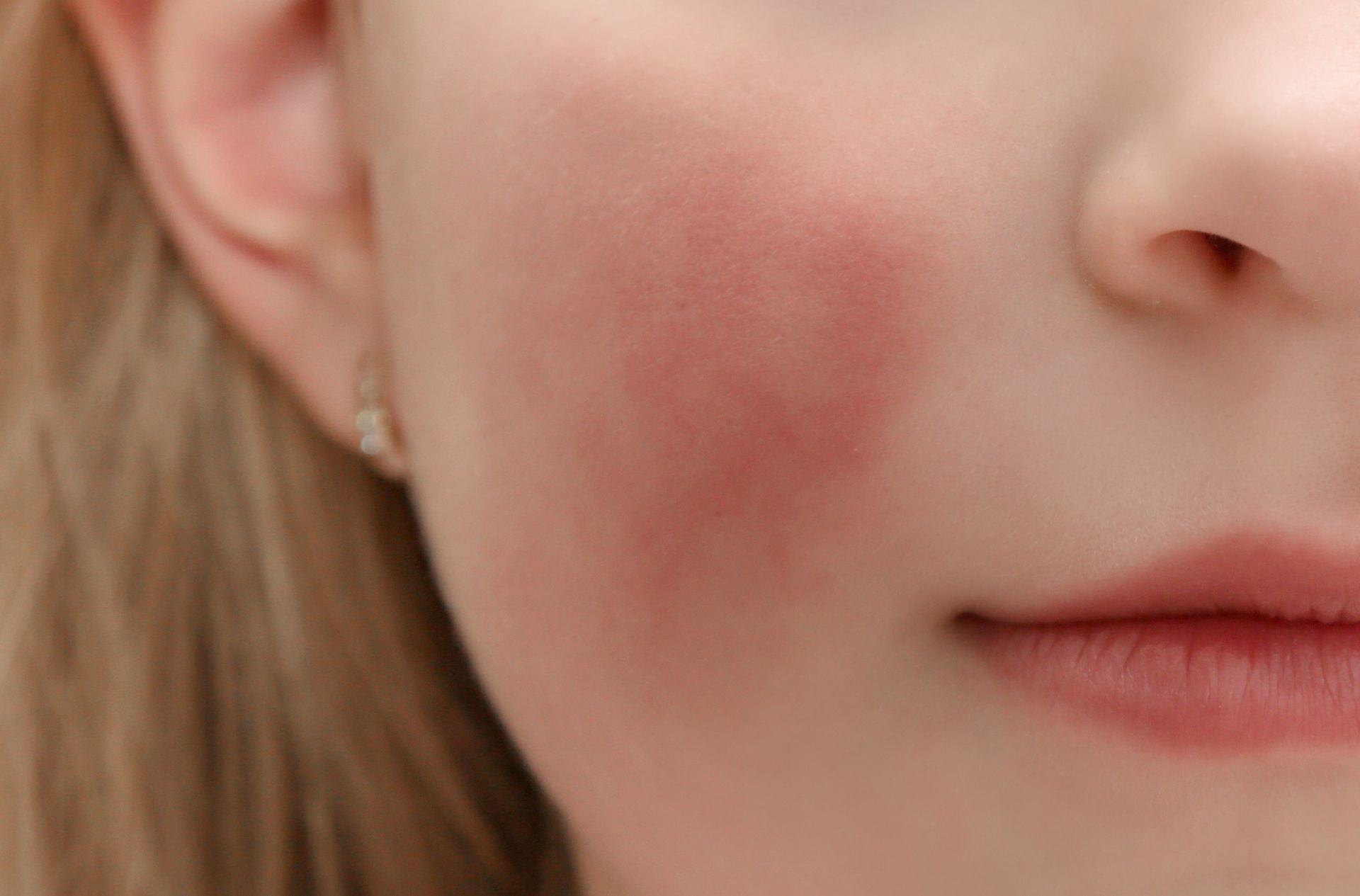 Close-up of a cheek with a red rash near the nose and mouth