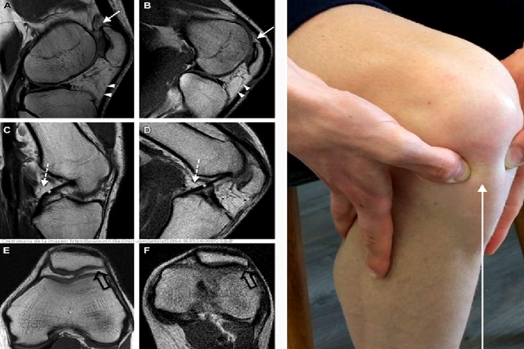 DR. ELIUT DEHESA CORTES - HOFFITIS