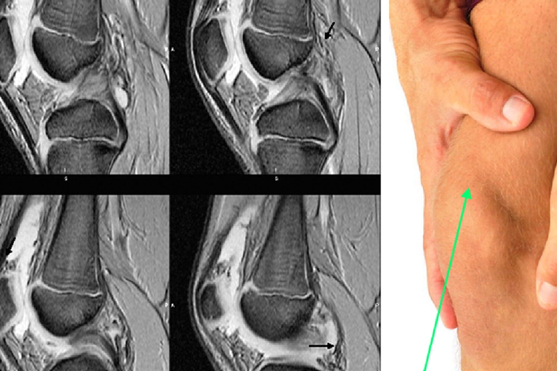 DR. ELIUT DEHESA CORTES - PLICAS SINOVIALES