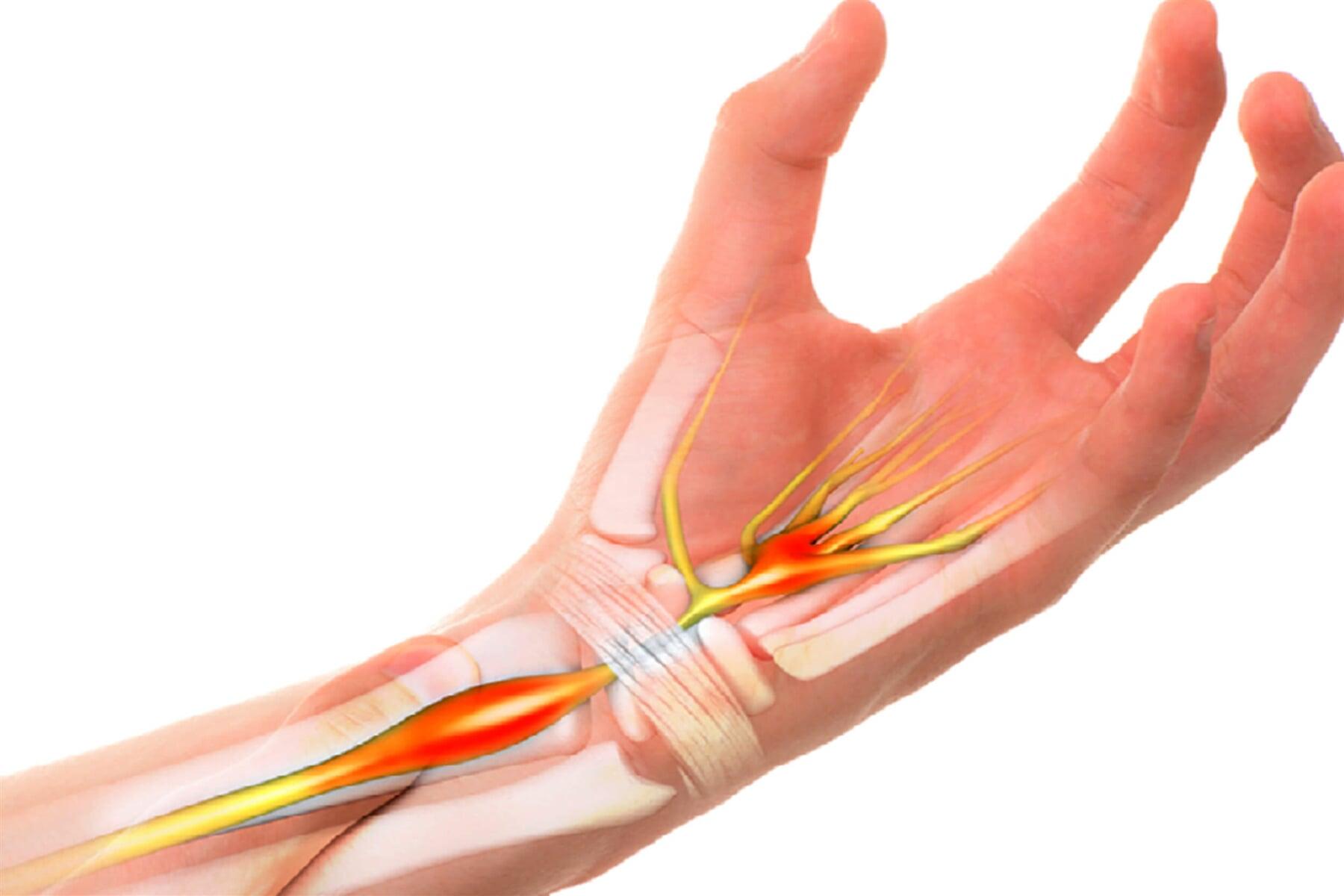 DR. ELIUT DEHESA CORTES - SINDROME DE TÚNEL CARPIANO