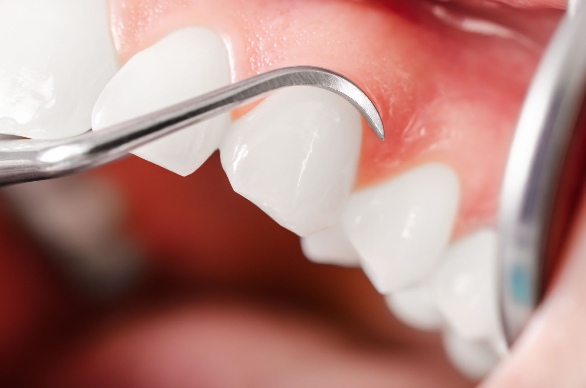A close-up of a person's teeth being examined by a dentist