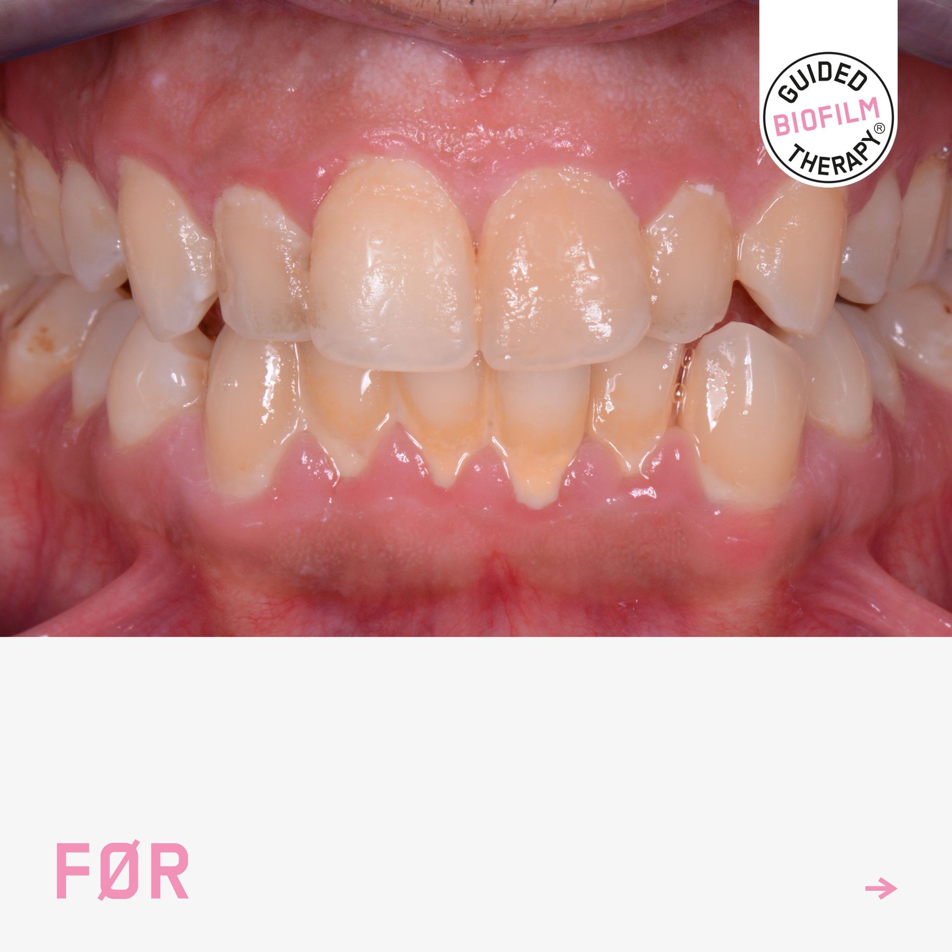 Tannbleking Dental Norge
