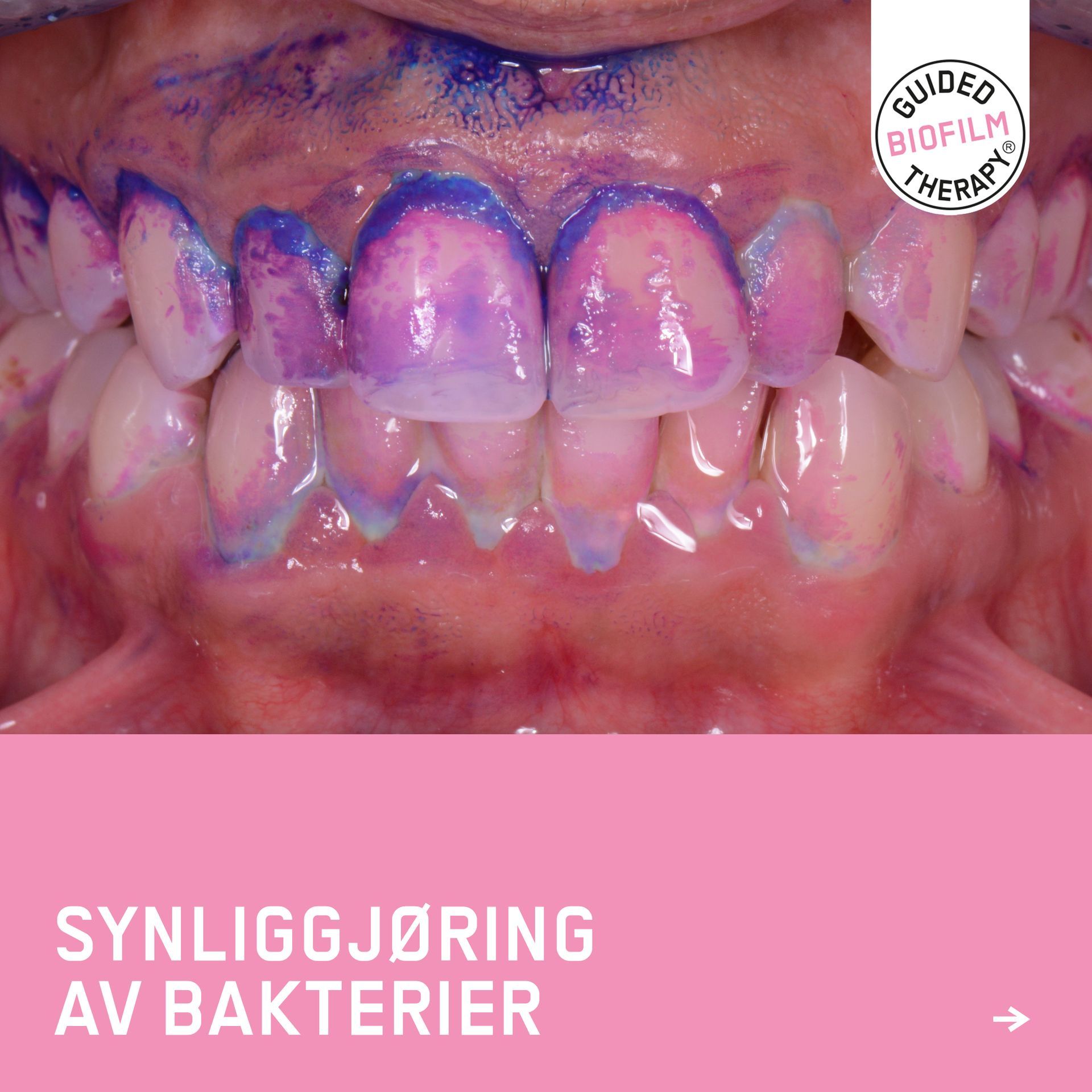 Tannbleking Dental Norge