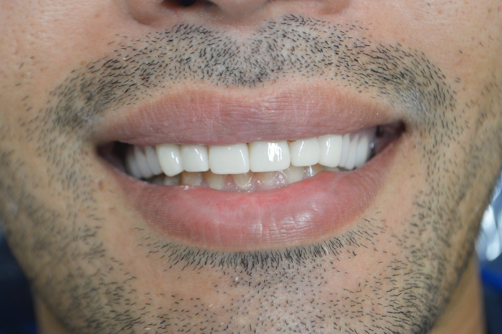 Close-up of a smiling mouth with white teeth and short facial stubble