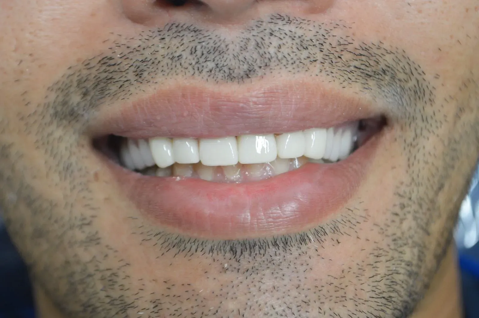 Close-up of a smiling mouth with visible teeth and light facial stubble