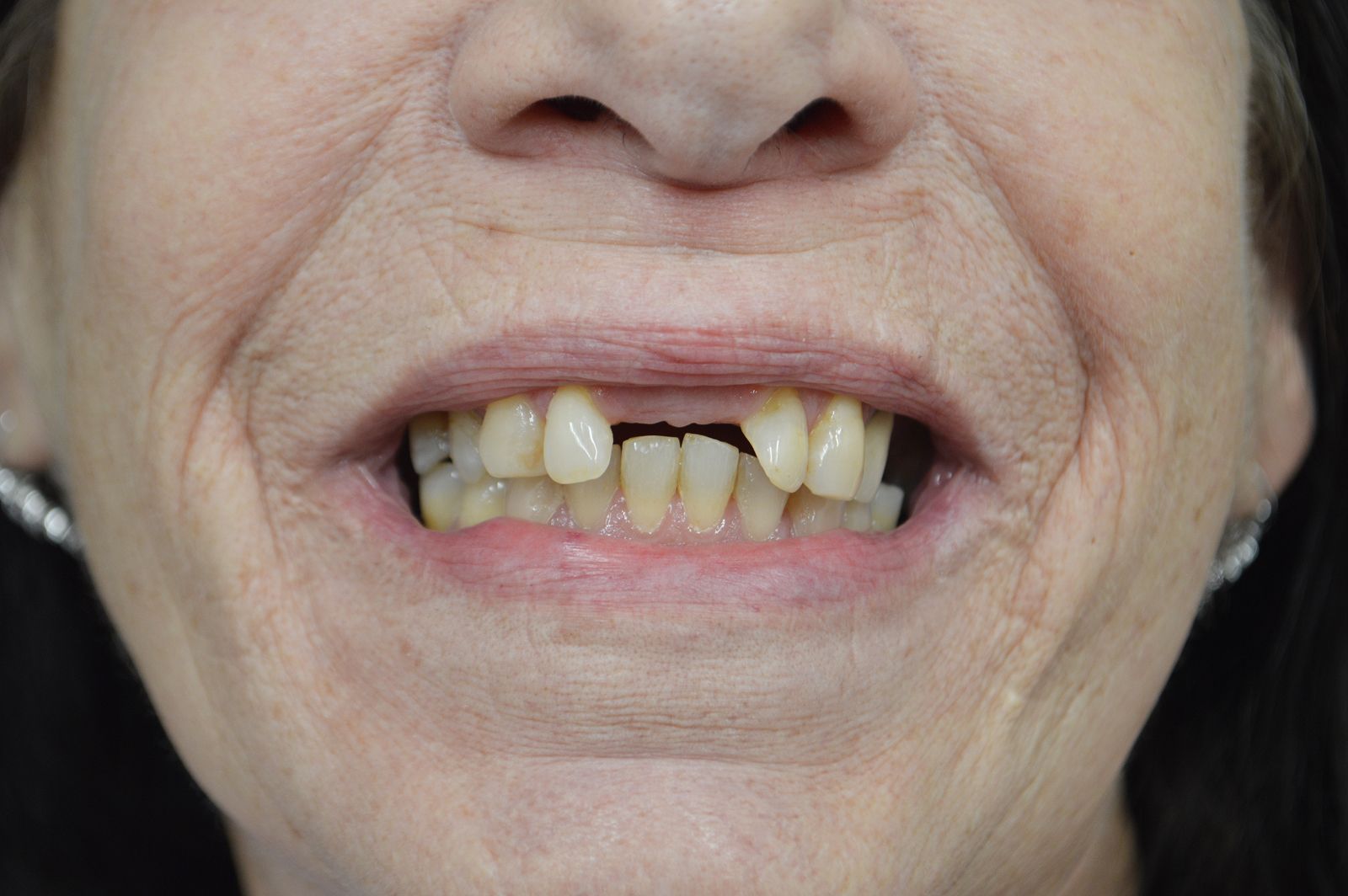 Close-up of a mouth with severely crooked, yellowed teeth and gaps