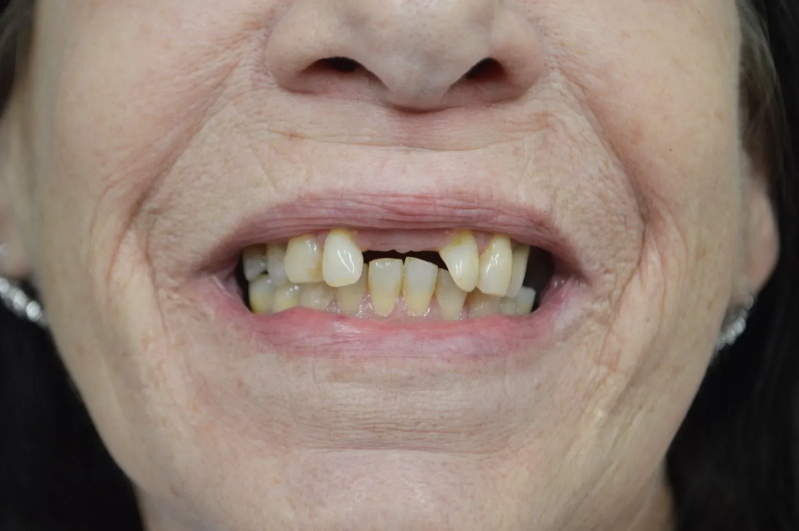 Close-up of a smiling mouth showing missing and crooked front teeth