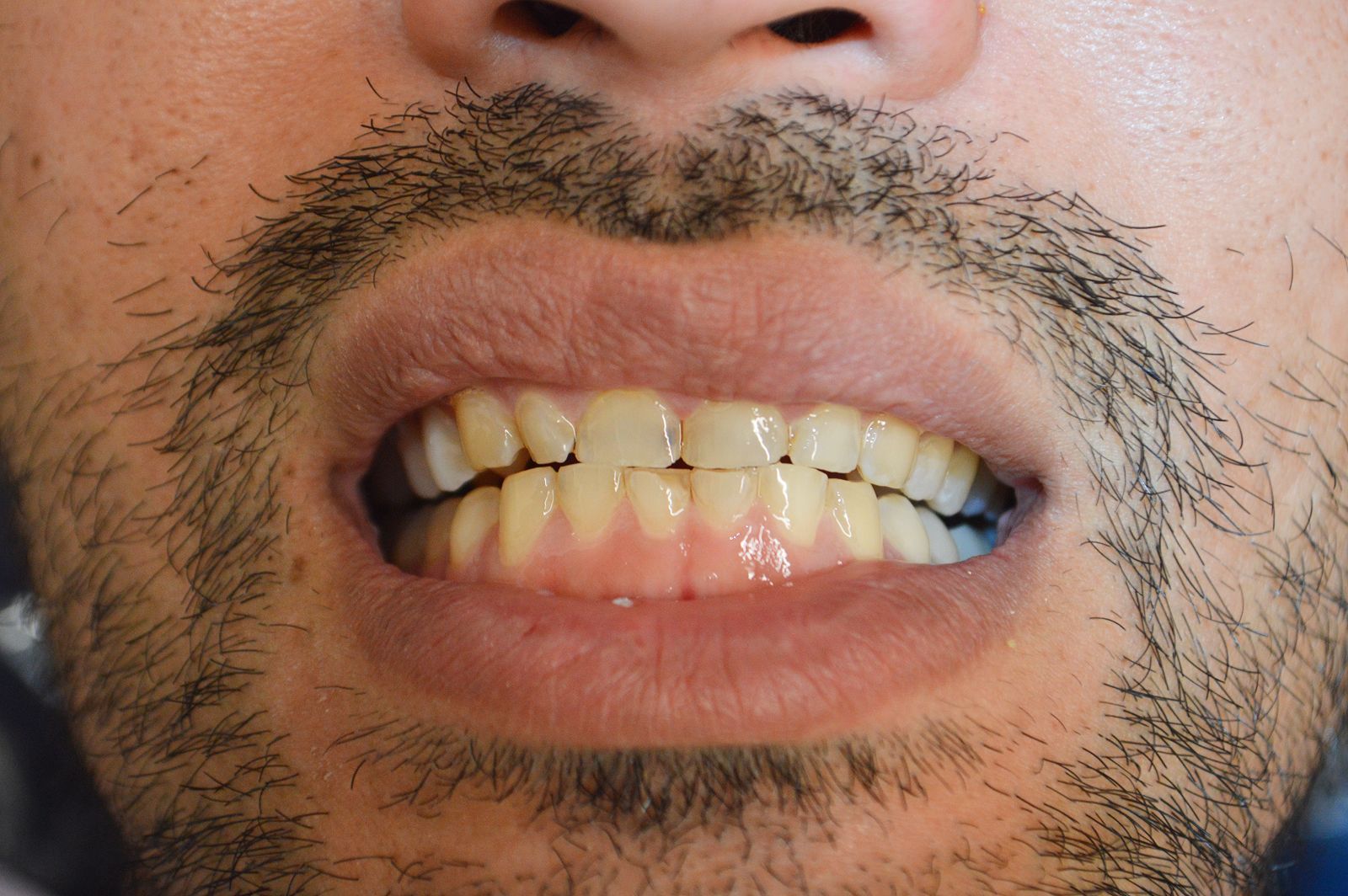 Close-up of a mouth with discolored teeth and facial stubble