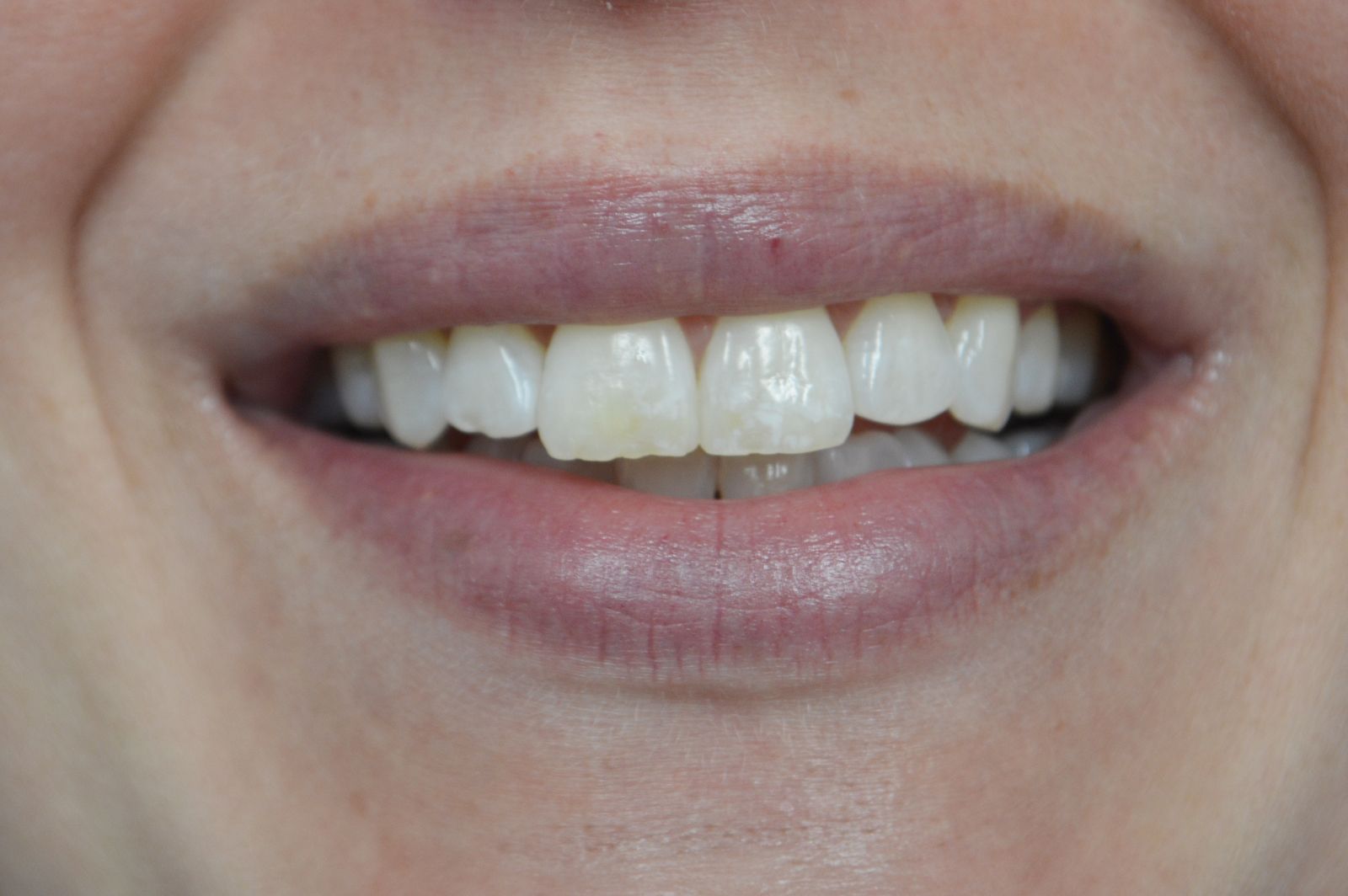 Close-up of a smiling mouth with slightly yellowed front teeth