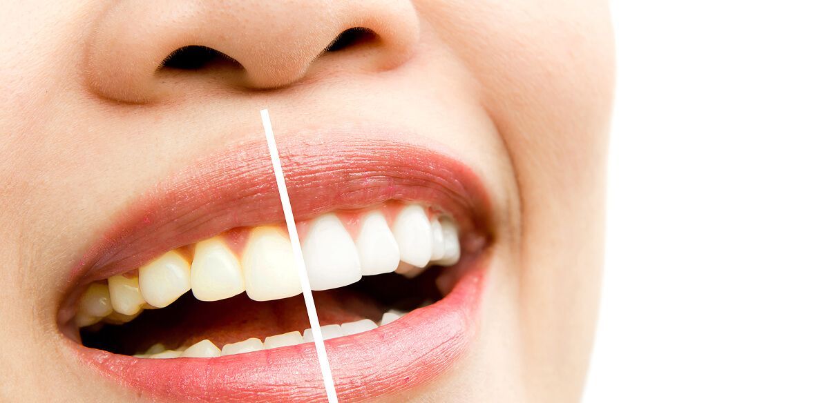 Woman's teeth, one side stained, the other side whitened, separated by a white line.