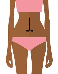Illustration of a person with a dotted line indicating a surgical incision on the abdomen.