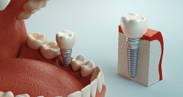 model of Implant Crown