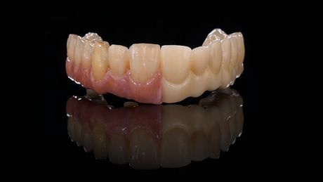 full arch implant bridges