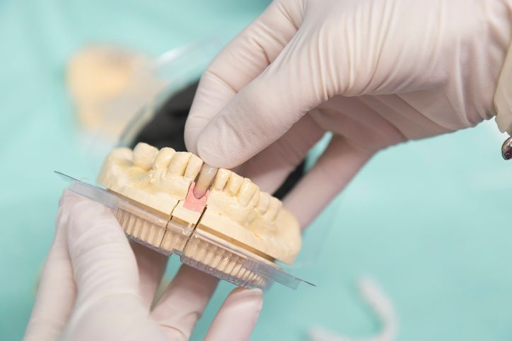 Dentist's gloved hands examining a dental mold of teeth.