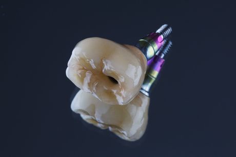 implant crowns