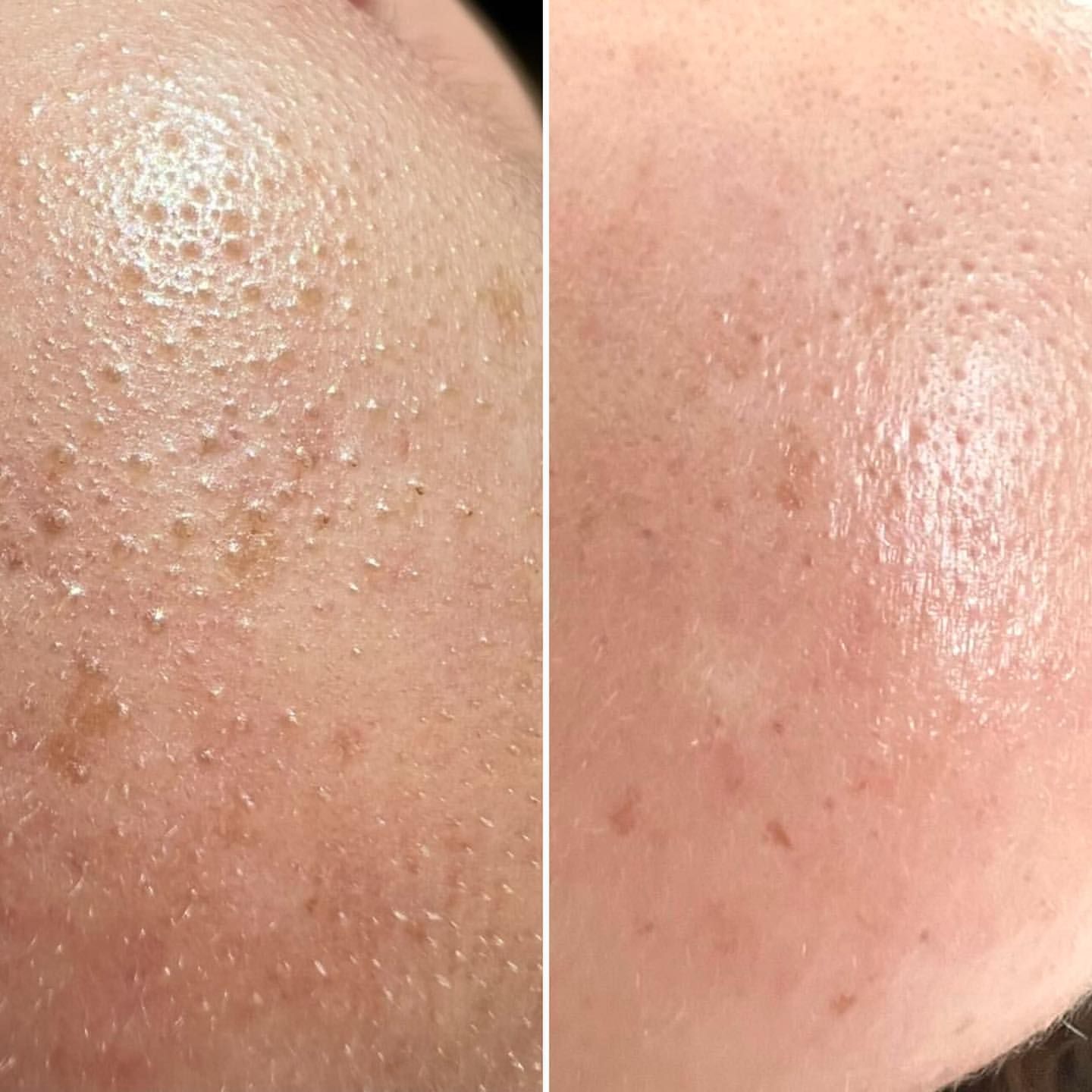 Hydrafacial Meta Therapy