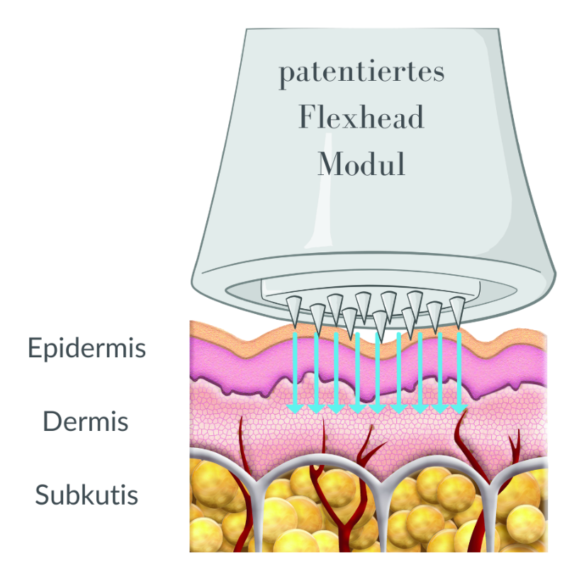 Querschnitt der Haut mit einem injizierenden „Flexhead“-Modul, beschriftet mit „Epidermis“, „Dermis“, „Subcutis“.