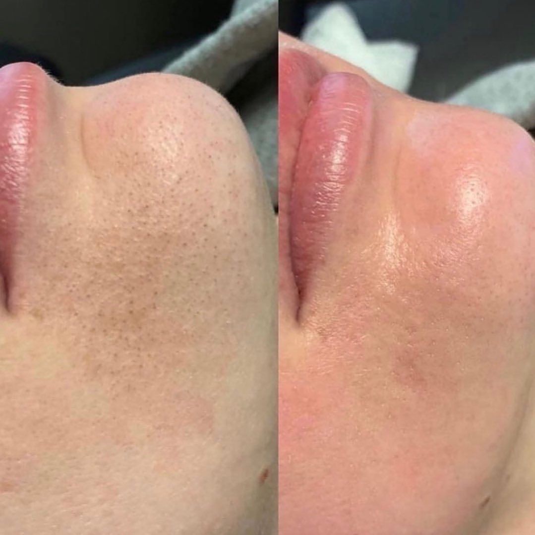 Hydrafacial original