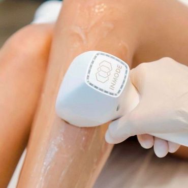 DioLaze XL. Ein Bein wird mit einem InMode-Haarentfernungsgerät behandelt. Weißes Gerät, behandschuhte Hand und klares Gel.