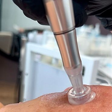 Nahaufnahme einer Meta Therapy im Gesicht einer Person; mit dem Gerät wird eine klare Flüssigkeit aufgetragen.