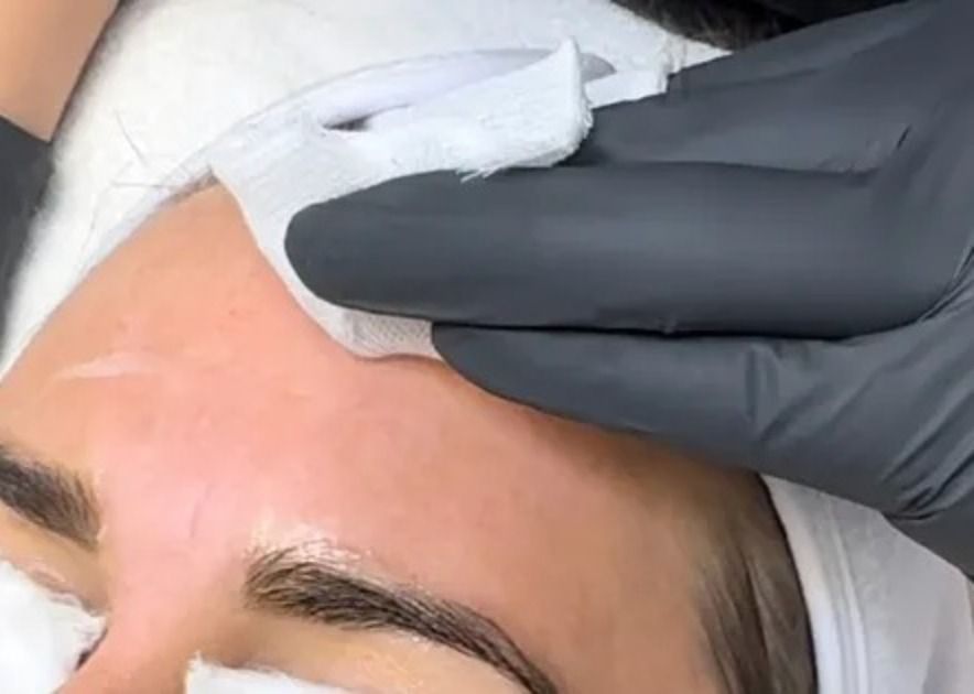 Chemisches Peeling im Studio in Bern: die Lösung wird mit dem Tupfer auf die Stirn aufgetragen