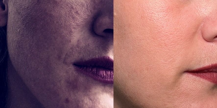 Pigmentflecken sichtbar gemacht: dieselbe Wange unter dem Observ-Licht und bei normalem Licht
