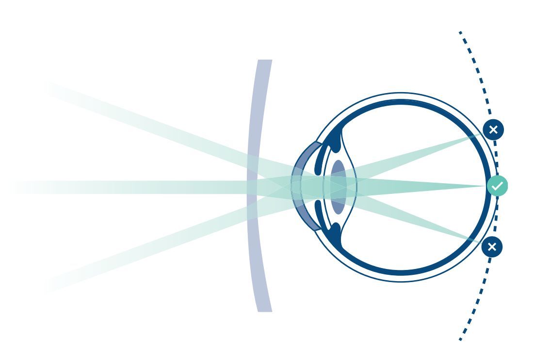 myopiemanagement kurzsichtigkeit bei Kindern und Jugendlichen