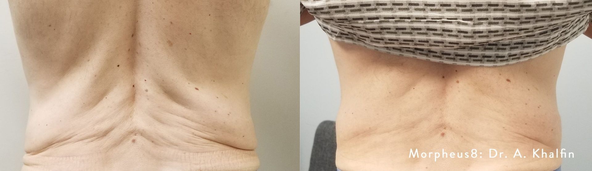A woman 's back is shown before and after surgery.