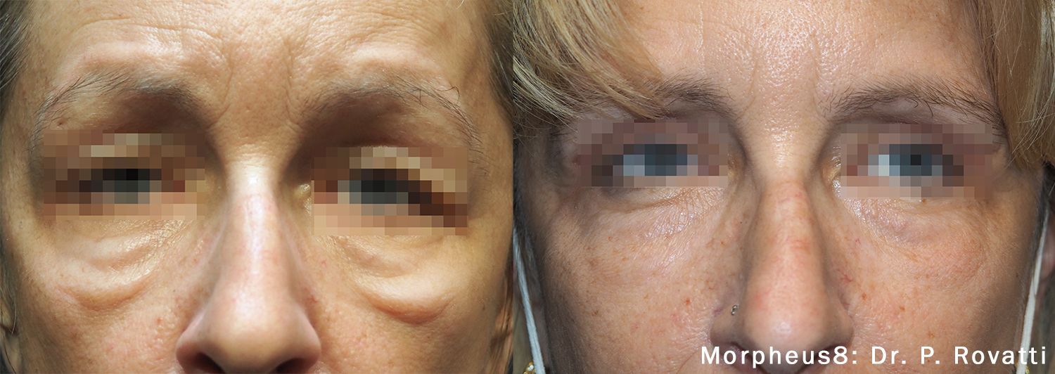 A before and after photo of a woman 's face.