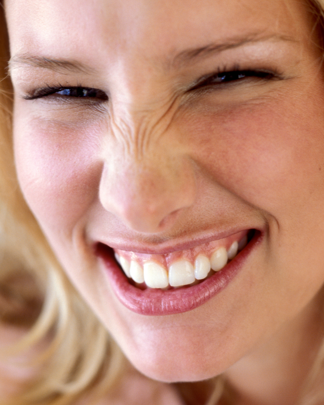 Bunny Nose Botox Houston TX