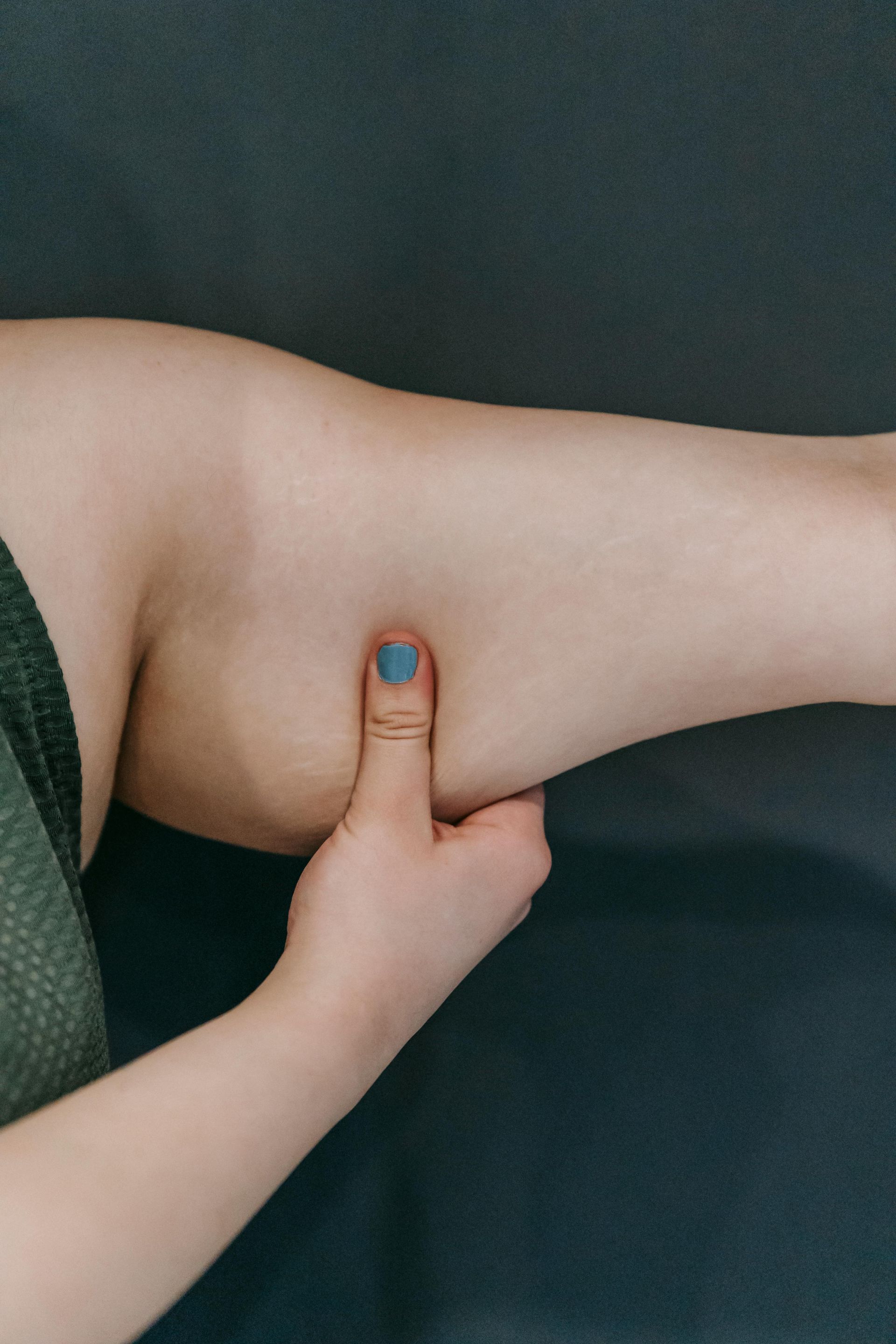 RF Skin Tightening